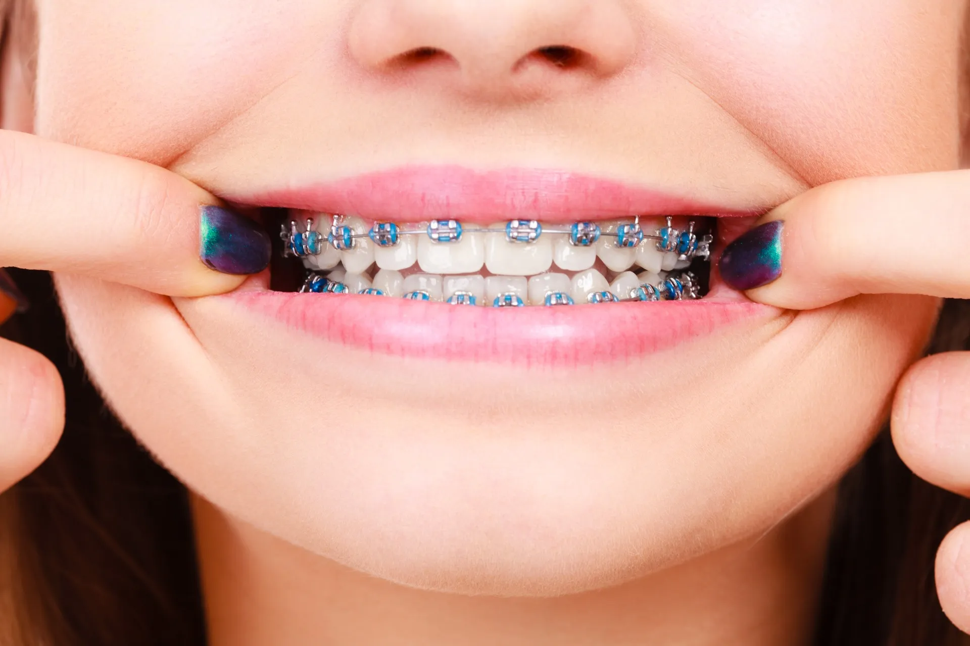 非抜歯矯正による美しい歯並びを手軽に実現！ワイヤー矯正のメリットとは？