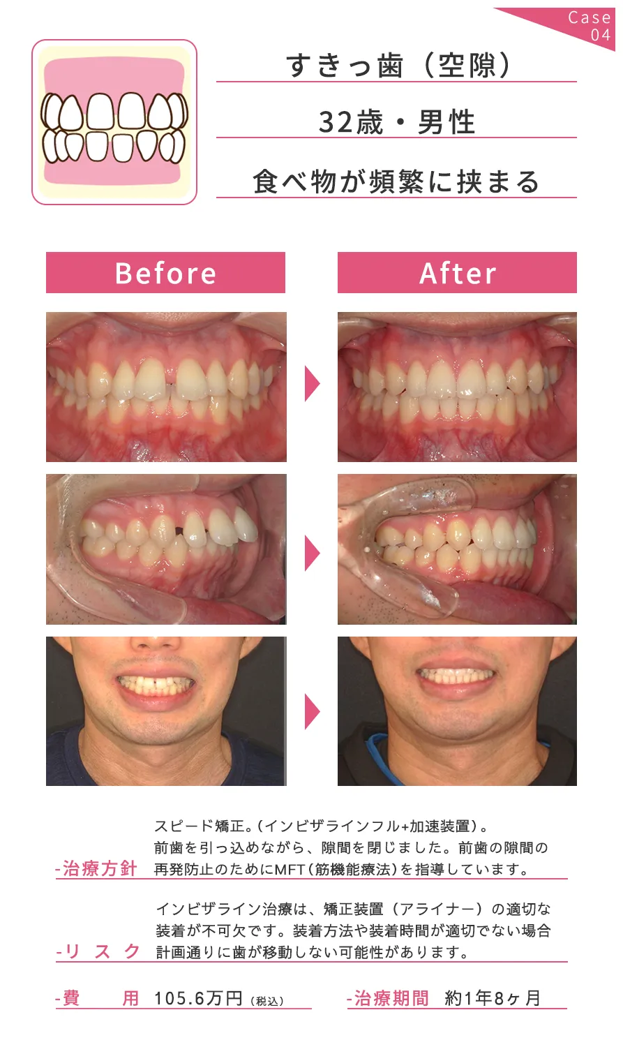 矯正歯科 (インビザライン、マウスピース矯正)｜ダイヤモンドドクター